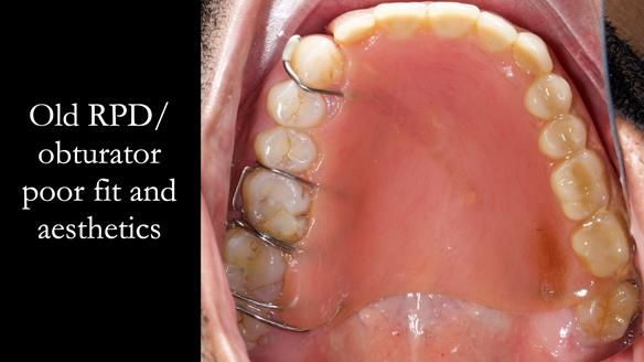 Upper metal base partial denture/occlusal stabilisation splint/obturator - full protocol