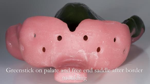 Finlay's Newsletter 60 Sylvia's upper Kennedy Class 2 Mod 1 metal based upper RPD