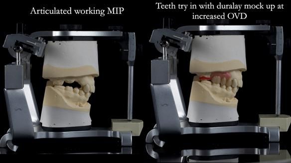 Finlay's Newsletter 60 Sylvia's upper Kennedy Class 2 Mod 1 metal based upper RPD