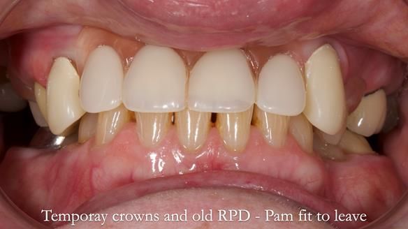 Newsletter 81 - Pam’s Story — how a partial denture changed her life (+ live walkthrough this Thursday)