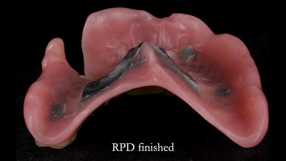 Newsletter 55 Provision of metal based partial dentures for Zephyrine with a repaired cleft lip and palate