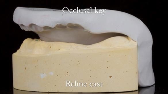 Finlay's Newsletter 62 provision of extractions and metal based complete dentures for Rafique