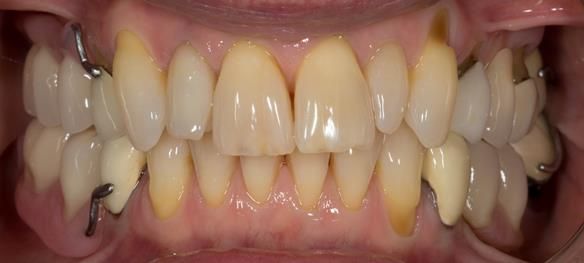 Figure 36 Immediate dentures fitting in ICP. Schottlander Enigmalife teeth.