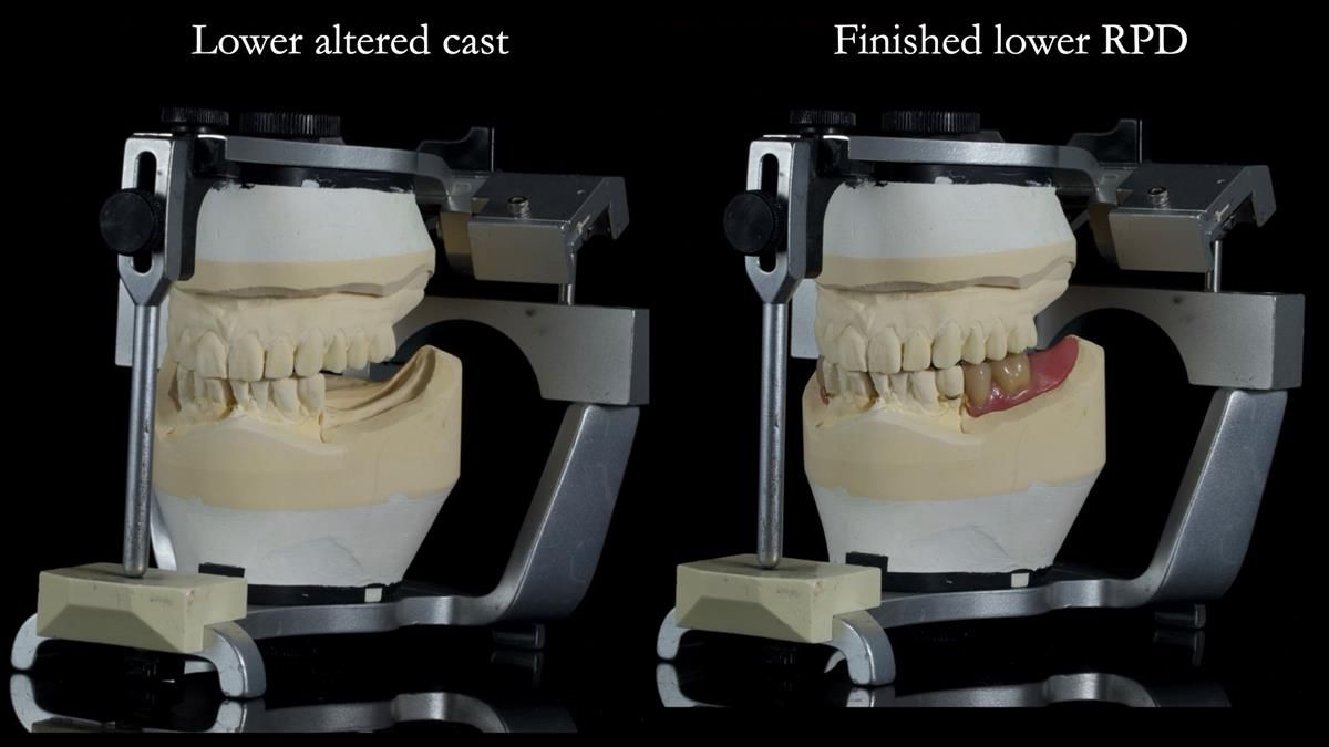 Newsletter 87 – Father Peter: A Partial Denture that needed Minor Miracle