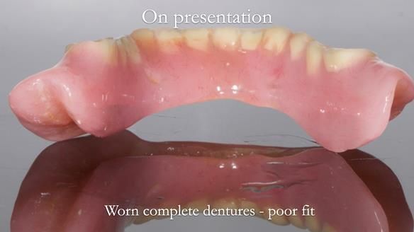Newsletter 57 showcases the making and fitting process of implant-supported complete dentures for Alisdair
