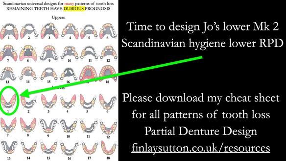 Newsletter 52 Managing Jo’s failing dentition with extractions and Mk 1/Mk 2 complete upper dentures and lower partial dentures FULL PROTOCOL