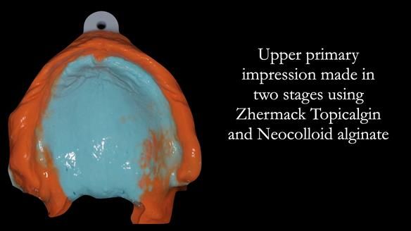 Managing poor implant positioning with complete dentures and Locator attachments - full protocol Newsletter 41
