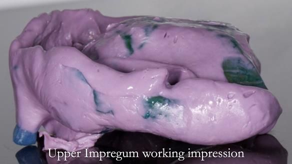 Newsletter 57 showcases the making and fitting process of implant-supported complete dentures for Alisdair