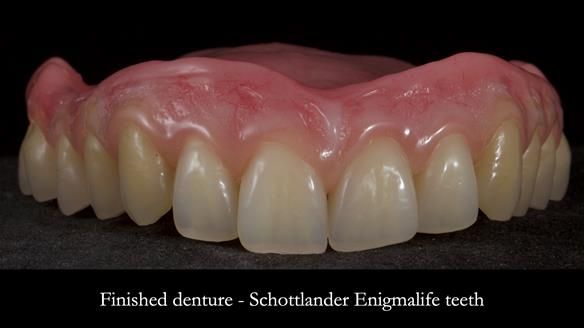 Newsletter 83: Sheila’s Complete Denture Success
