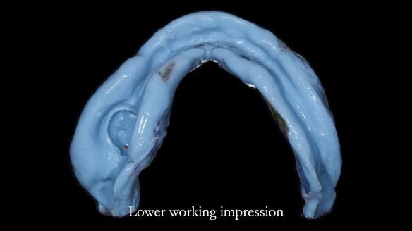 Newsletter 82 Mary - A complete upper and a one-tooth gasket denture