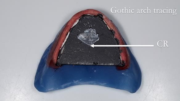 Newsletter 80 - Gordon’s dentures: the one case in 1,000 where my technique failed