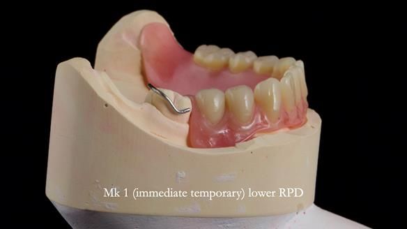 Newsletter 82 Mary - A complete upper and a one-tooth gasket denture