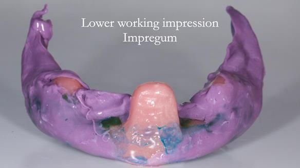 Replacing Madeline’s Complete denture FULL PROTOCOL