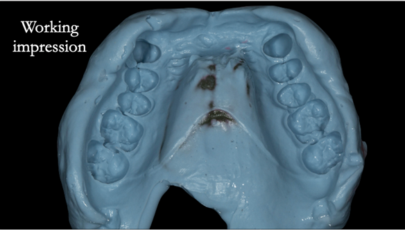 Figure 58 Working impression upper in custom tray with greenstick and alginate