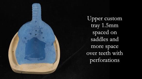 Newsletter 56 showing the making and fitting of a bilateral free end saddle upper removable partial denture (RPD) for patient with pemphigus