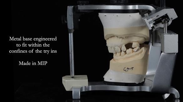 Finlay's Newsletter 61 provision of a lower unilateral free end saddle metal based partial denture for Joyce