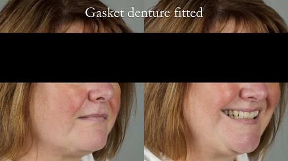 Finlay's Newsletter 58 Gasket upper partial denture for Zoe