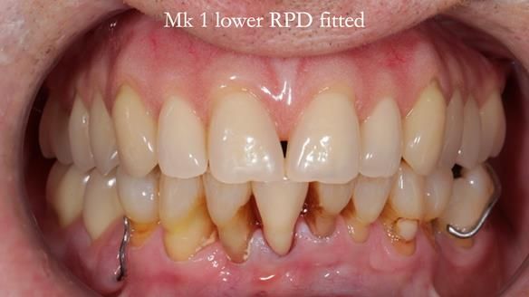 Newsletter 54 case presentation upper complete denture and lower Scandinavian designed hygienic partial denture for David