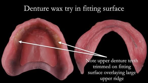 Newsletter 50 Special edition Complete Dentures FULL PROTOCOL