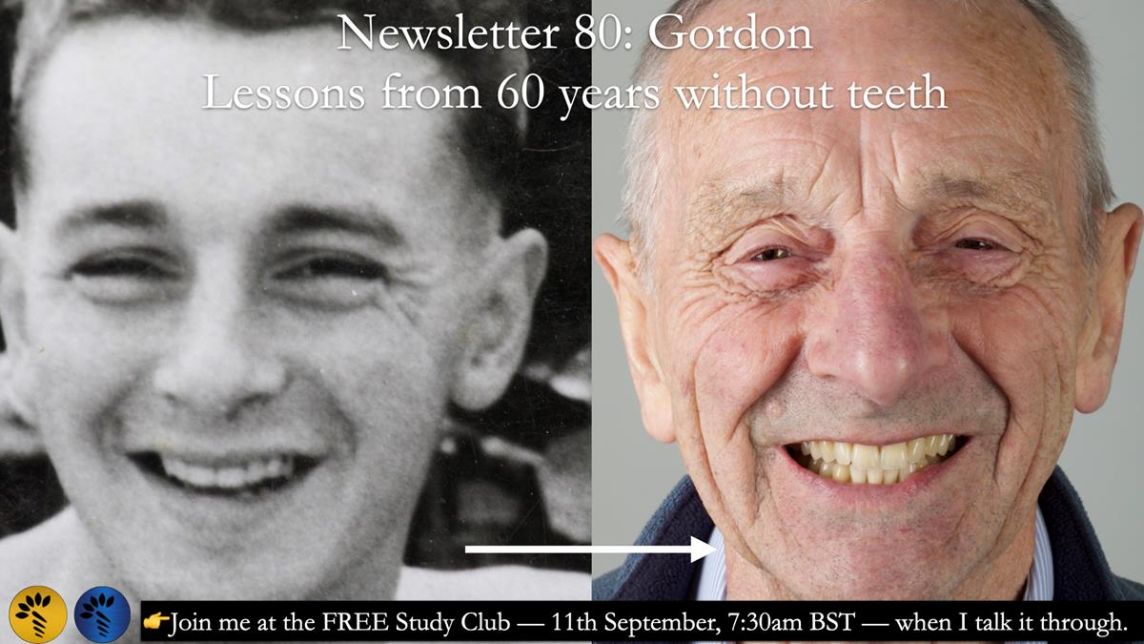 Newsletter 80 - Gordon’s dentures: the one case in 1,000 where my technique failed