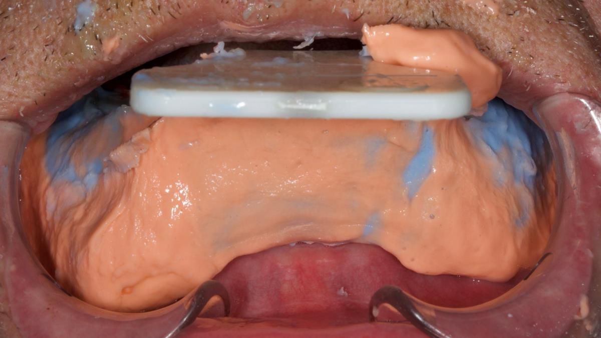 Fin’s Newsletter 88 — Complete dentures - full protocol… he rearranged his own teeth!