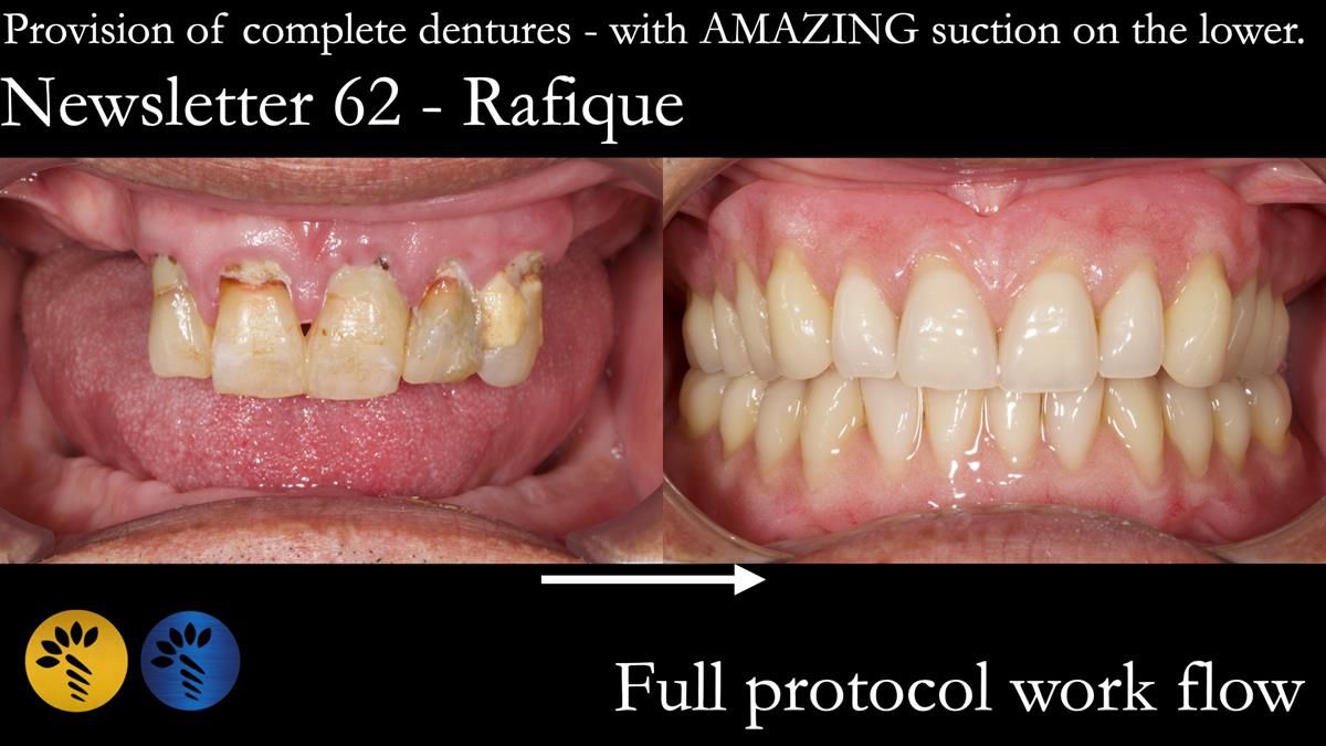 Finlay's Newsletter 62 provision of extractions and metal based complete dentures for Rafique