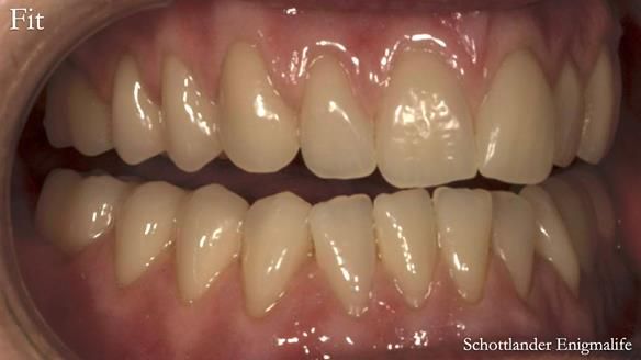 Newsletter 75: Marion’s case - Step-by-step complete denture workflow