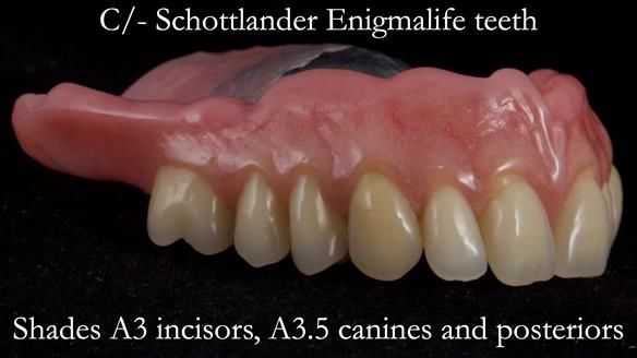 Newsletter 54 case presentation upper complete denture and lower Scandinavian designed hygienic partial denture for David