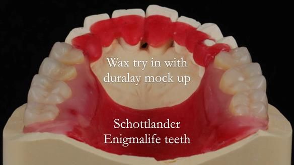 Newsletter 56 showing the making and fitting of a bilateral free end saddle upper removable partial denture (RPD) for patient with pemphigus
