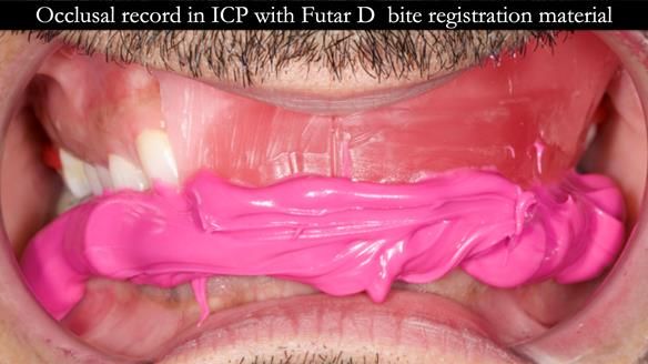 Upper metal base partial denture/occlusal stabilisation splint/obturator - full protocol