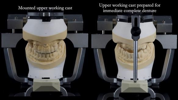 Newsletter 77: Jeremy’s case – immediate complete upper denture