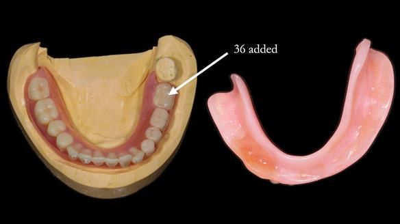 Finlay's Newsletter 59 Ultra hard partial dentures made for Gill