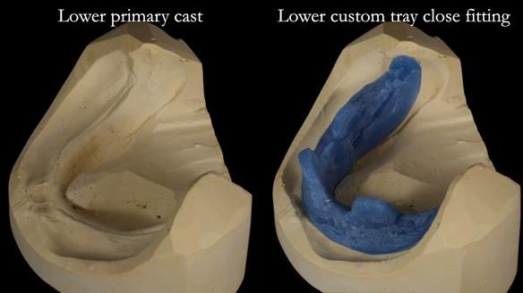 Newsletter 83: Sheila’s Complete Denture Success