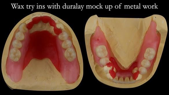 Finlay's Case Study Newsletter 40 - Immediate Mk 1 RPD to Definitive Mk 2 RPD - full protocol