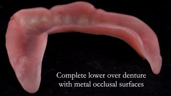 Newsletter 44 - extreme removable prosthodontics – engineering a super-strong and ultra-thin over denture