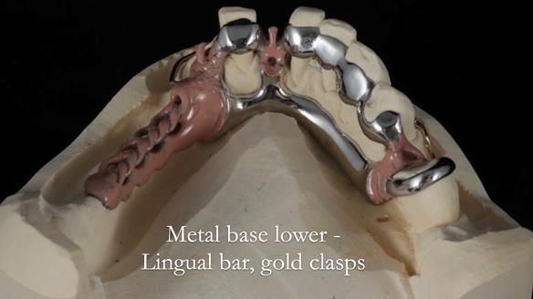 Newsletter 55 Provision of metal based partial dentures for Zephyrine with a repaired cleft lip and palate