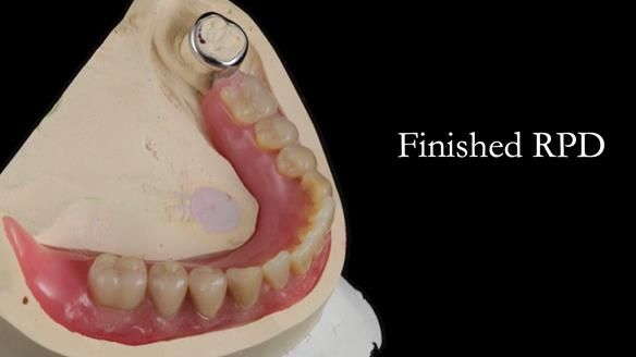 Finlay's Newsletter 59 Ultra hard partial dentures made for Gill