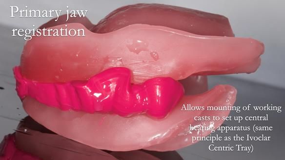 Newsletter 53 showing the making and fitting of ultra life-like dentures for Valena