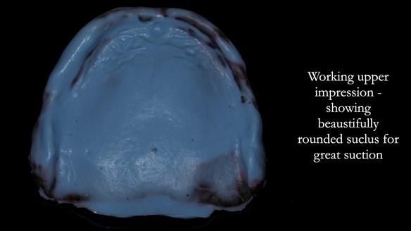 Newsletter 83: Sheila’s Complete Denture Success