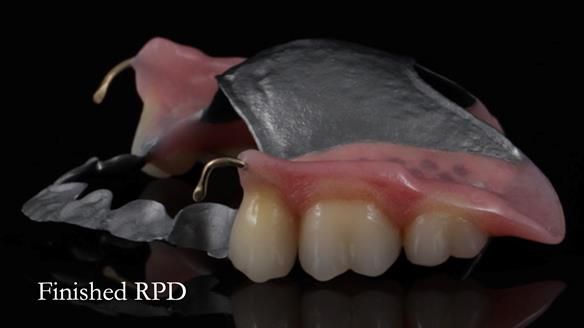 Newsletter 56 showing the making and fitting of a bilateral free end saddle upper removable partial denture (RPD) for patient with pemphigus