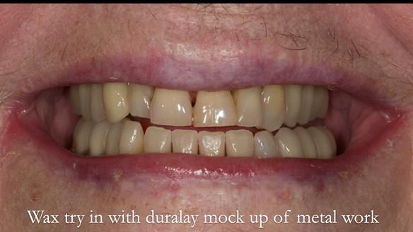 Finlay's Case Study Newsletter 40 - Immediate Mk 1 RPD to Definitive Mk 2 RPD - full protocol