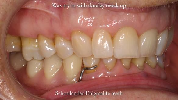 Finlay's Newsletter 61 provision of a lower unilateral free end saddle metal based partial denture for Joyce