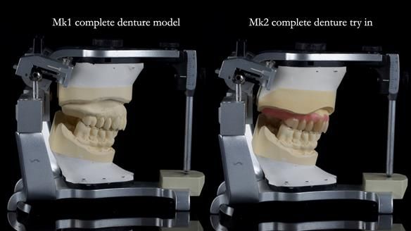 Newsletter 77: Jeremy’s case – immediate complete upper denture