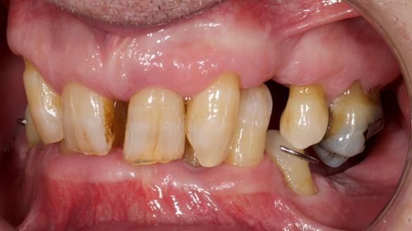 Newsletter 86 Peter the Architect — precision removable partial dentures case study