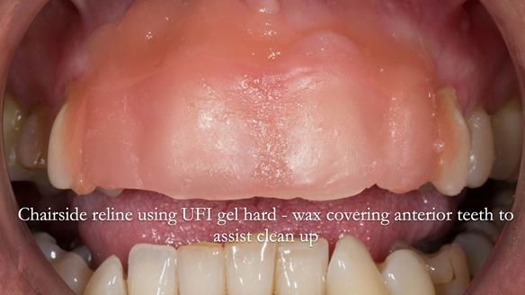 Finlay's Newsletter 63 Case study provision of metal based Scandinavian RPD - functional 10 years on