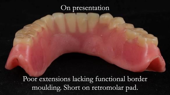 Finlay's Newsletter 62 provision of extractions and metal based complete dentures for Rafique