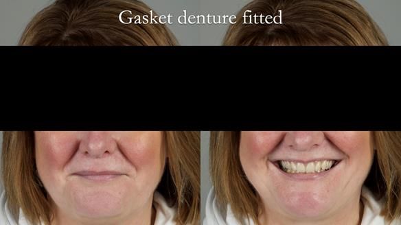 Finlay's Newsletter 58 Gasket upper partial denture for Zoe