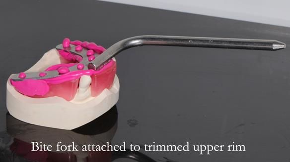 Finlay's Newsletter 59 Ultra hard partial dentures made for Gill