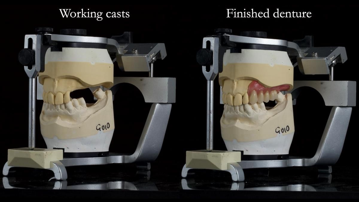 Newsletter 89 – Simon: A Challenging Kennedy Class II Division 1 Upper CoCr Partial Denture with a High Smile Line