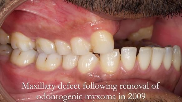 Upper metal base partial denture/occlusal stabilisation splint/obturator - full protocol